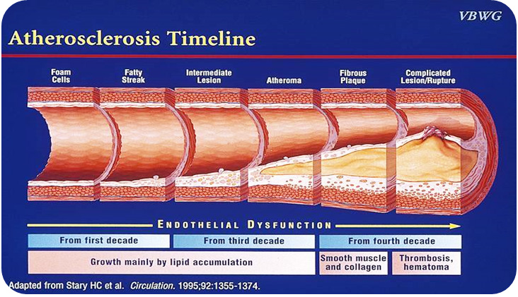 Atherosclerosis Timeline